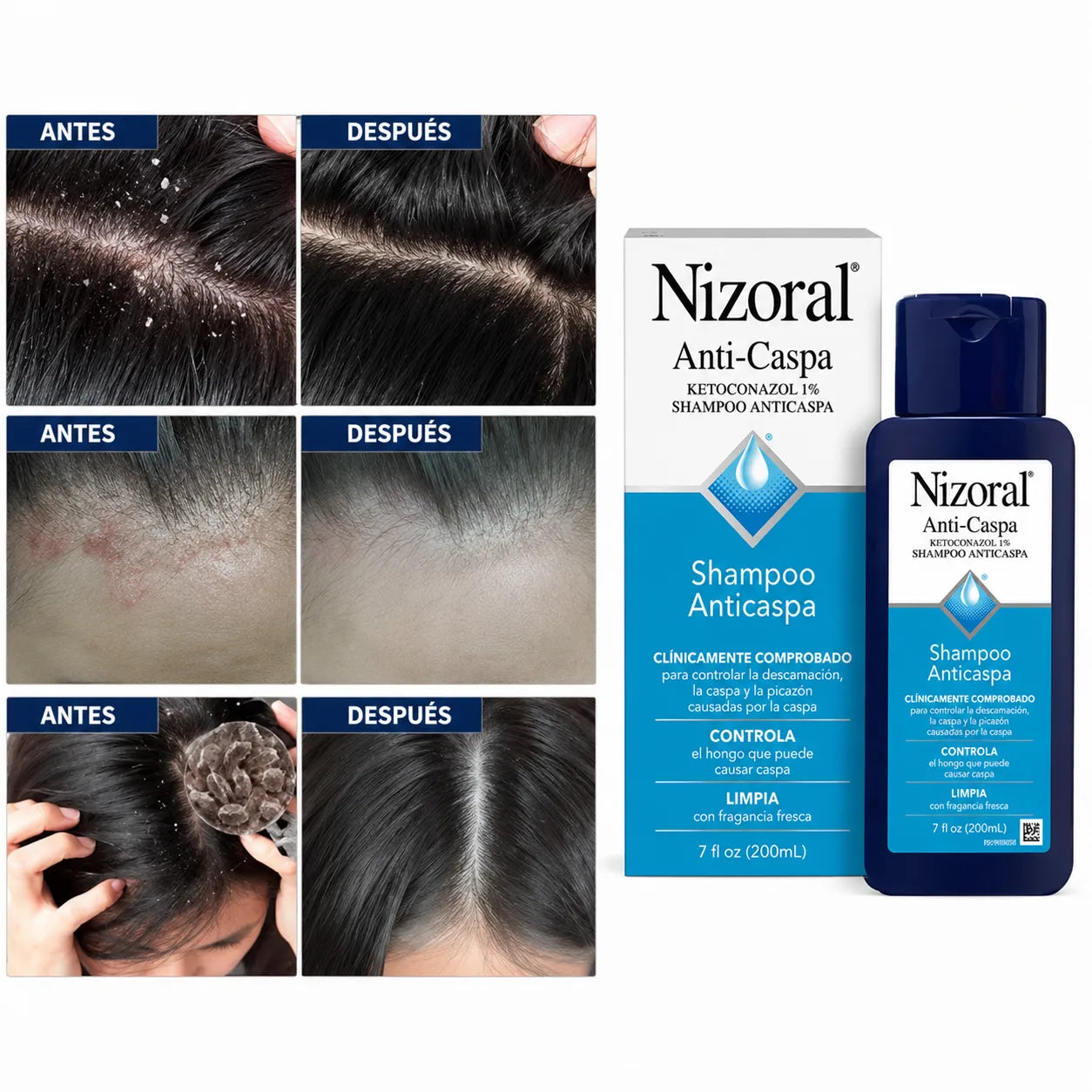 Shampoo Anticaspa ¡Dile adiós al picor constante en el cuero cabelludo!