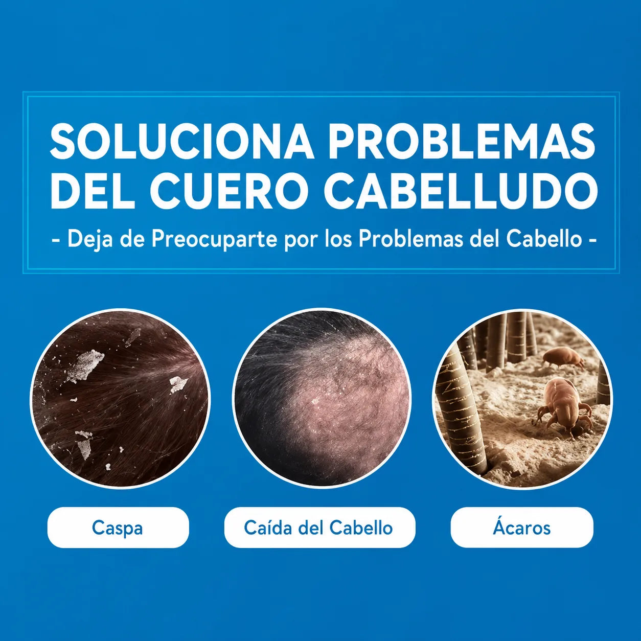 Shampoo Anticaspa ¡Dile adiós al picor constante en el cuero cabelludo!