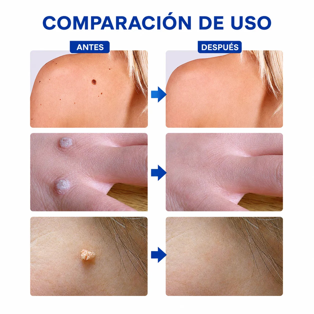 CREMA REMOVEDORA DE VERRUGAS ¡Sin dolor, aplicación suave y 100% natural!