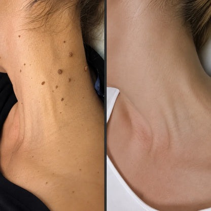 CREMA REMOVEDORA DE VERRUGAS ¡sin doctor, sin dolor y sin gastar una fortuna!