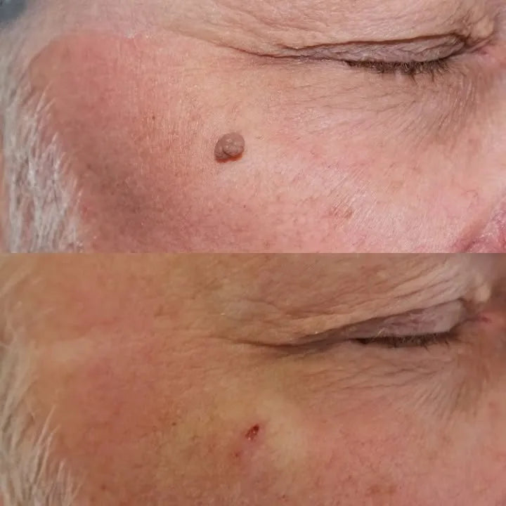 CREMA REMOVEDORA DE VERRUGAS ¡sin doctor, sin dolor y sin gastar una fortuna!