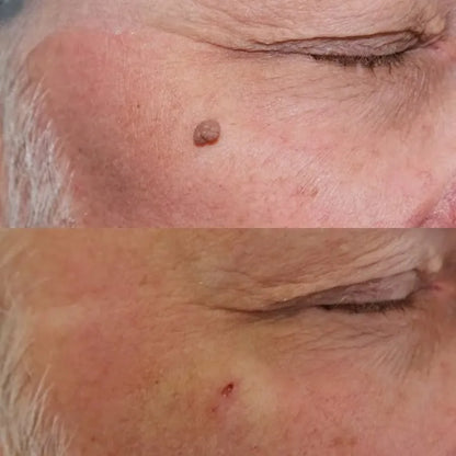 CREMA REMOVEDORA DE VERRUGAS ¡sin doctor, sin dolor y sin gastar una fortuna!