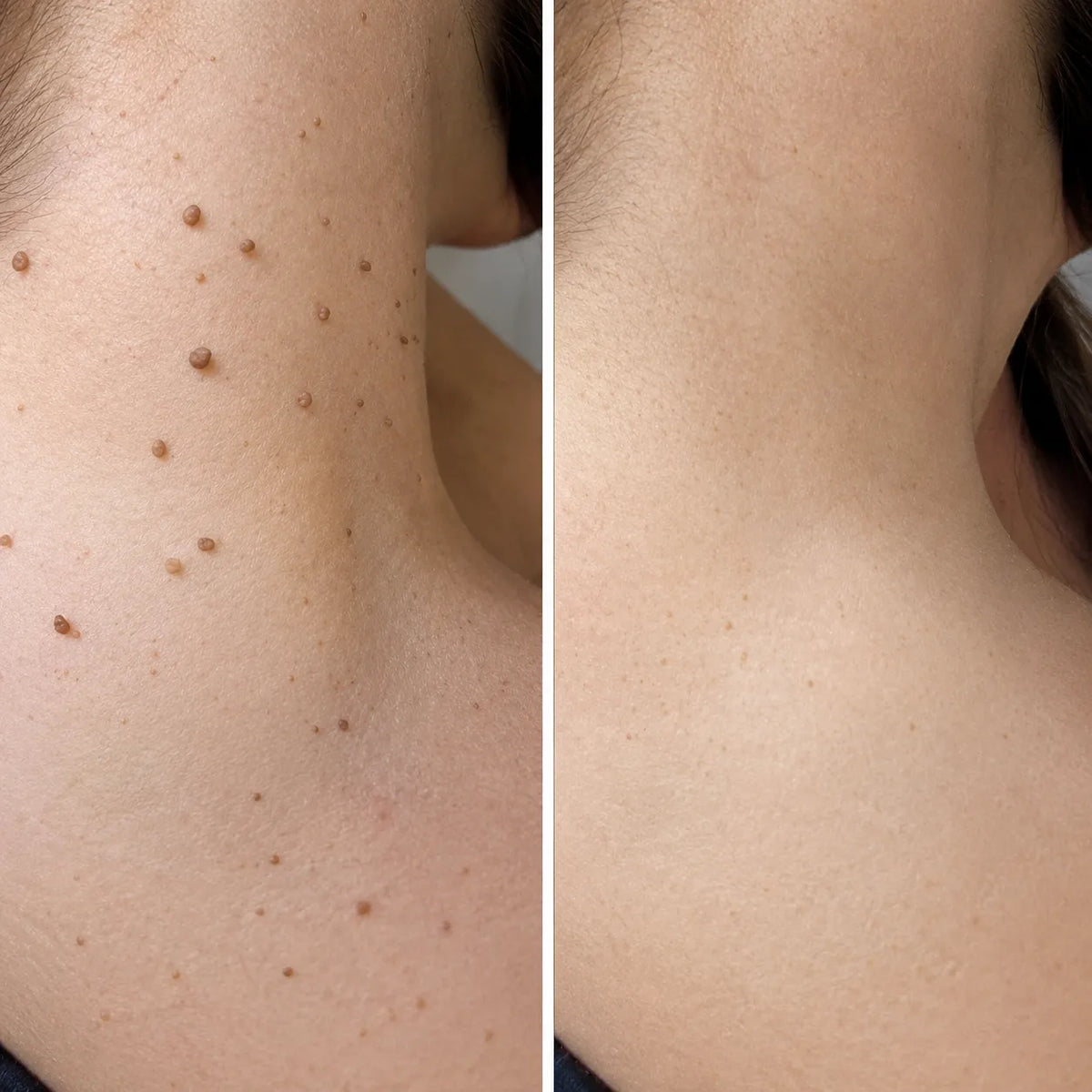 CREMA REMOVEDORA DE VERRUGAS ¡sin doctor, sin dolor y sin gastar una fortuna!