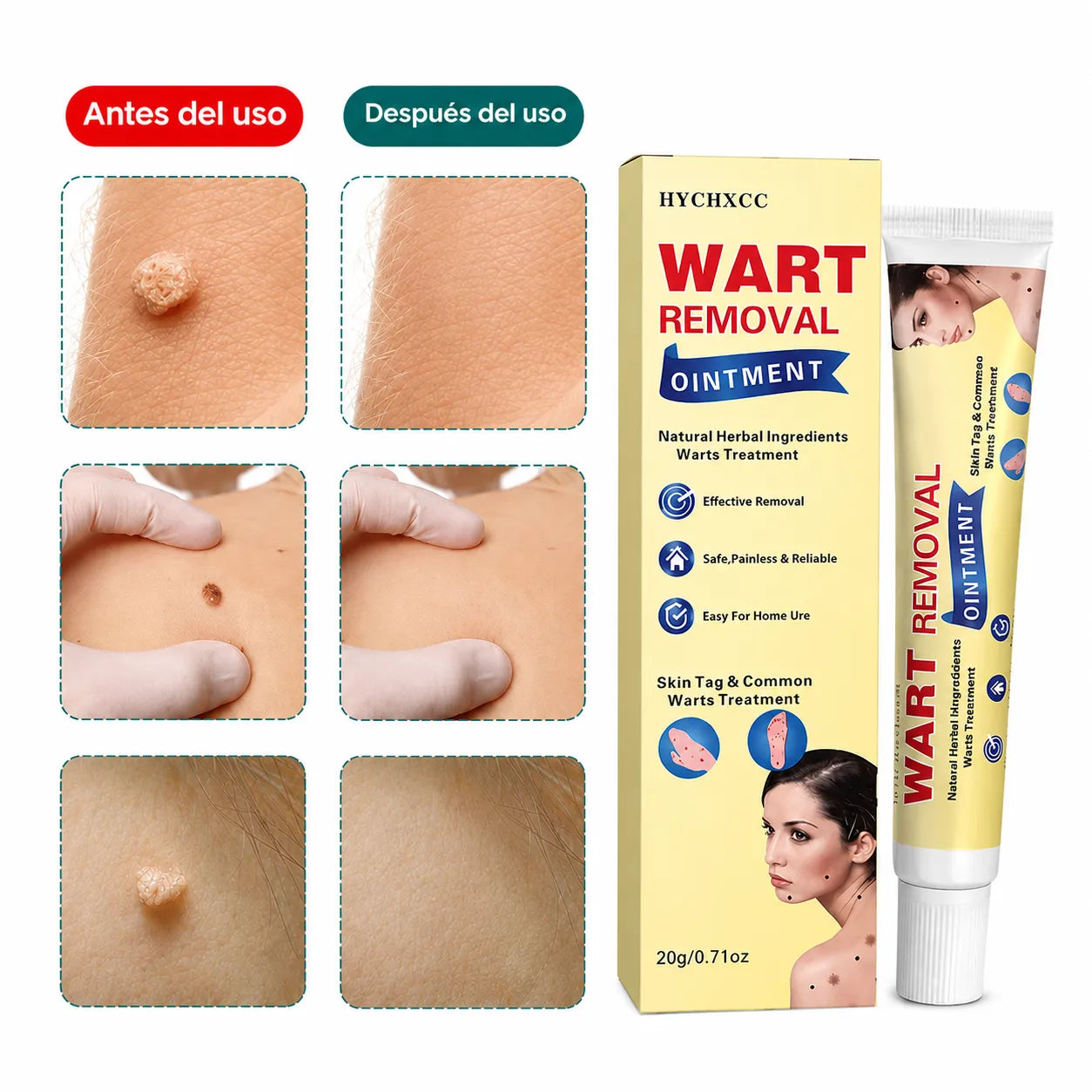 CREMA REMOVEDORA DE VERRUGAS ¡Sin dolor, aplicación suave y 100% natural!